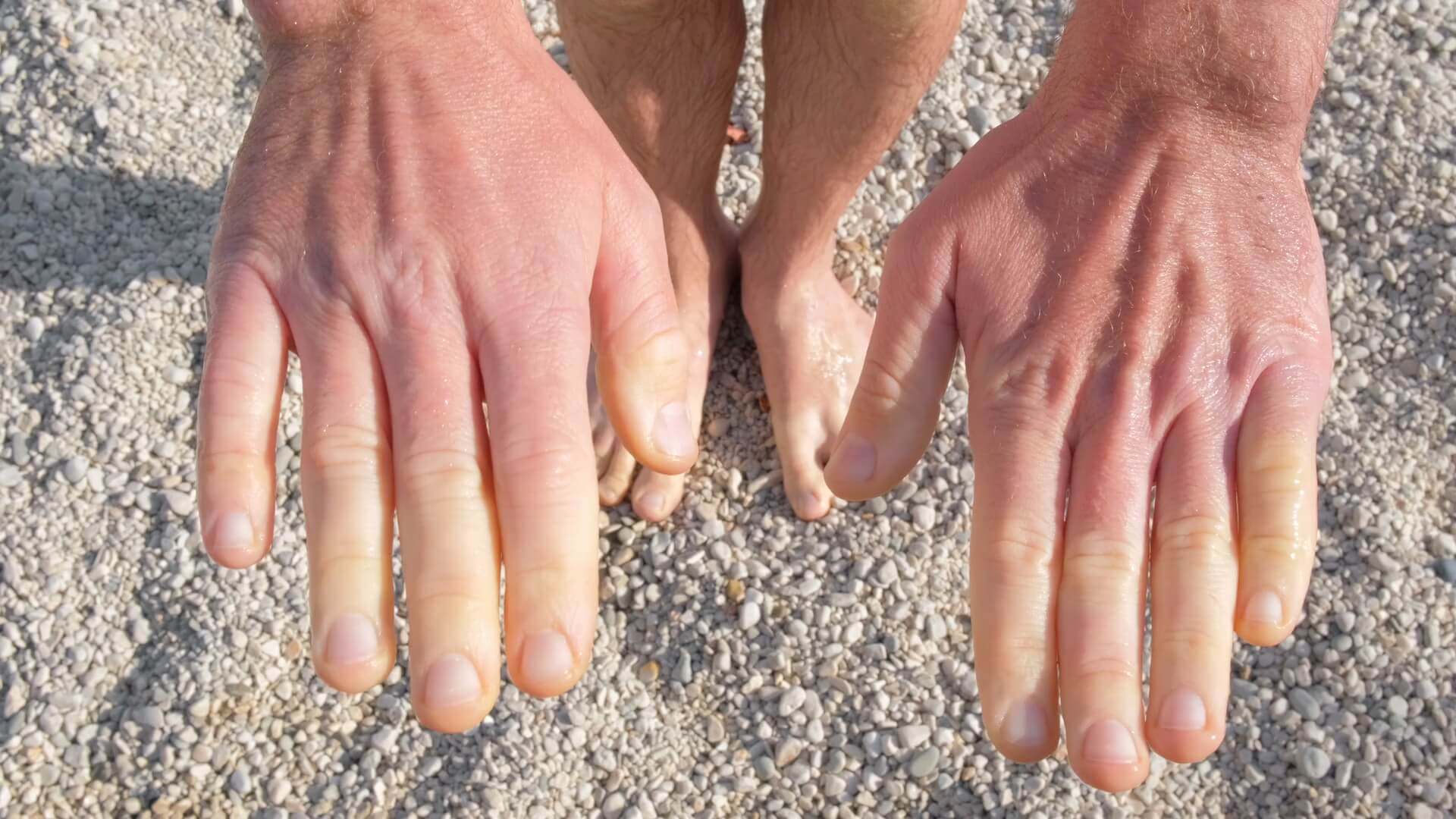 Close-up of hands exhibiting the lighter coloration of Raynaud's phenomenon